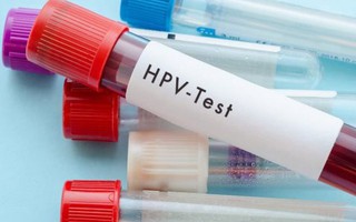 Nhiễm virus HPV dai dẳng là nguy cơ chính gây ung thư cổ tử cung