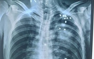 Tuyên Quang: Thêm 1 bệnh nhân bị 20 viên đạn găm khắp lồng ngực 