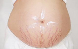 Cách khắc phục rạn da khi mang thai và sau sinh hiệu quả 