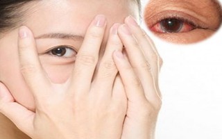 Cảnh báo các bệnh viêm kết mạc mắt gia tăng trong mùa hè