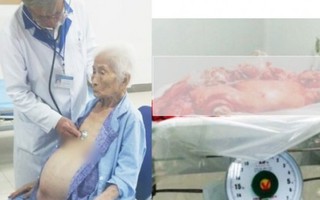 Lấy khối u 13kg khỏi cụ bà 100 tuổi