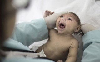 Em bé châu Âu đầu tiên bị chứng đầu nhỏ