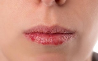 8 nguyên nhân gây nứt nẻ môi và cách phòng tránh
