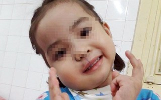 'Giải cứu' bé gái 4 tuổi khỏi u quái vùng mặt