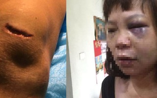Quảng Ninh: Nữ hộ lý bị chồng lừa lên đồi đánh đập dã man, cắt gân