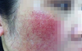 Dùng mỹ phẩm 'nhái', phụ nữ ngậm đắng đi điều trị da