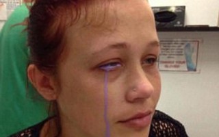Xăm tròng mắt, cô gái có nguy cơ bị mù khi khóc ra mực tím