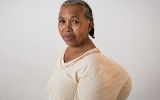 Người phụ nữ ‘cõng’ trên lưng khối u 4,5kg suốt 40 năm 