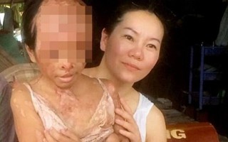 Cộng đồng giúp đỡ bé gái Việt bị tạt axit 