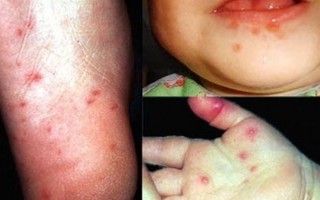 Hà Nội xuất hiện virus chân tay miệng gây tử vong