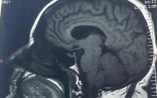 U não to bằng quả bóng golf bị chẩn đoán nhầm thành mãn kinh 