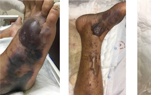 Nhiễm "vi khuẩn ăn thịt người" từ biển, người bệnh bị biến chứng suy đa tạng chỉ sau vài giờ, gia đình xin đưa về nhà lo hậu sự