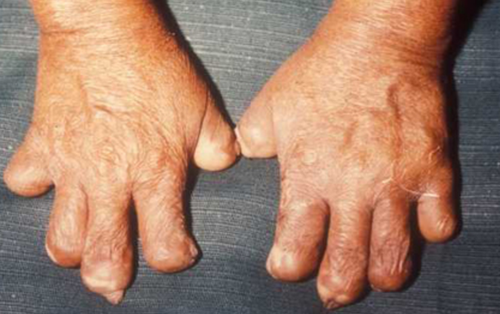 Bệnh phong cùi và những kỳ thị sai lầm không còn đúng trong thời hiện đại