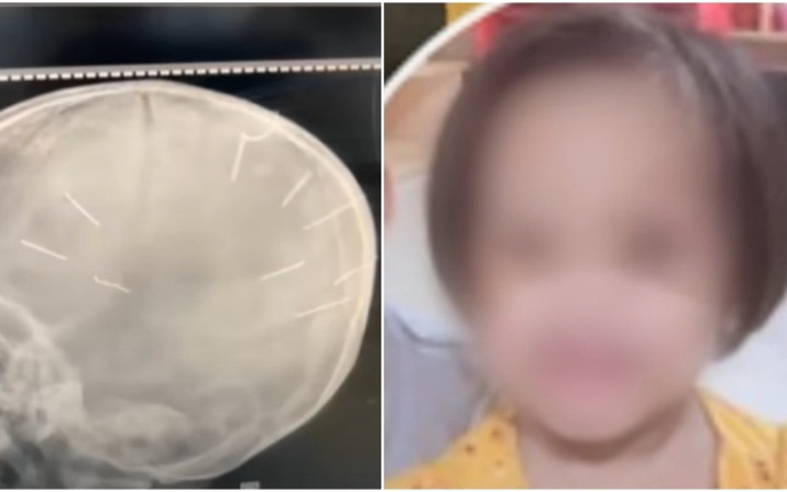 Hội LHPN TP Hà Nội thăm hỏi bé gái 3 tuổi bị người tình của mẹ đóng 9 chiếc đinh vào đầu